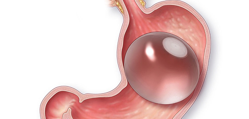 Ilustración de balón intragástrico